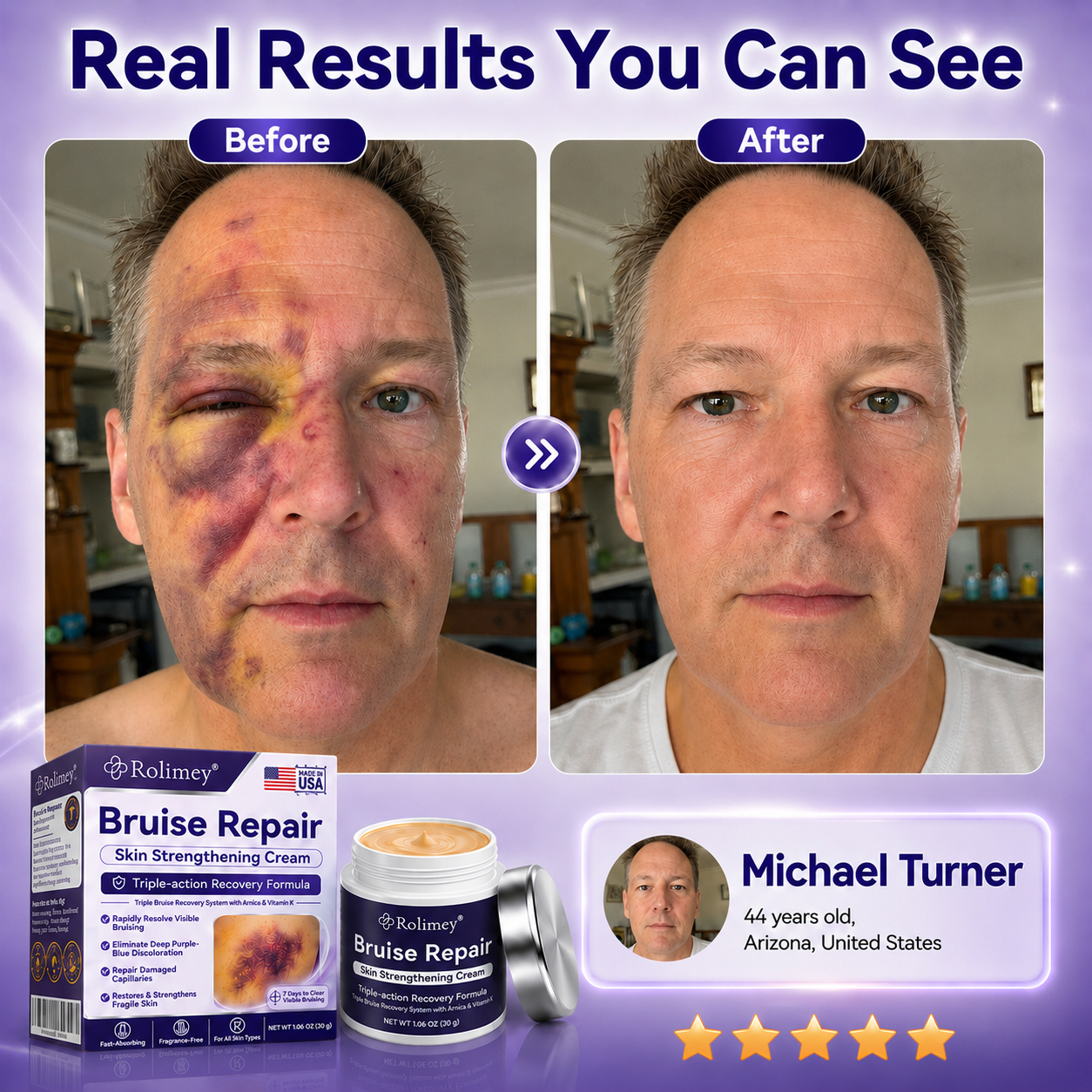 Rolimey® cream to repair bruises and strengthen the skin.