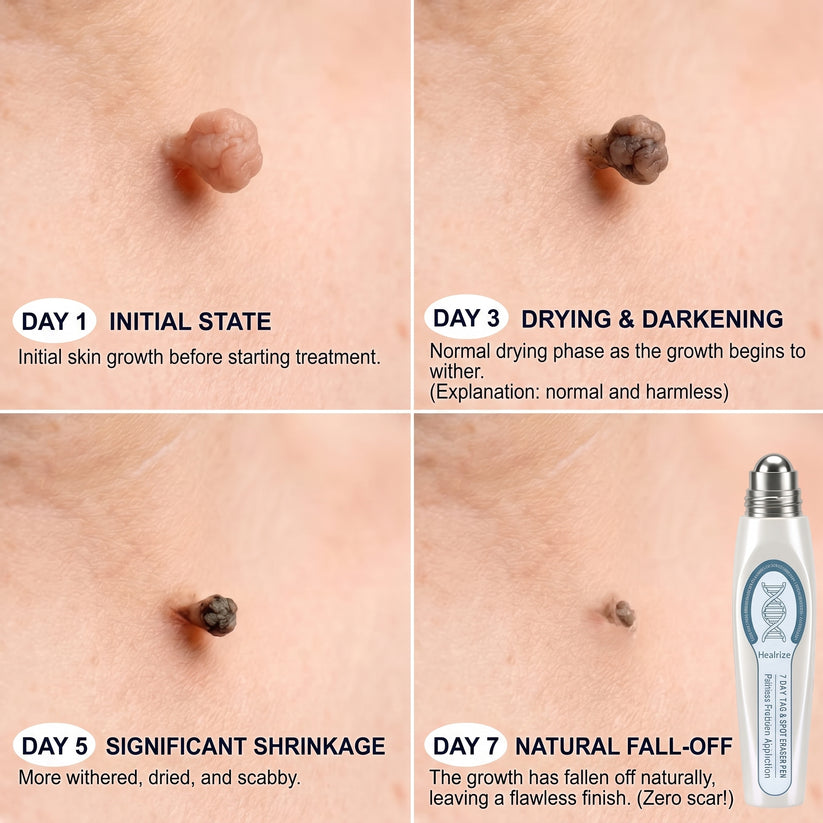 Healrize® 🖊 Advanced Wart & Skin Tag Removal Pen