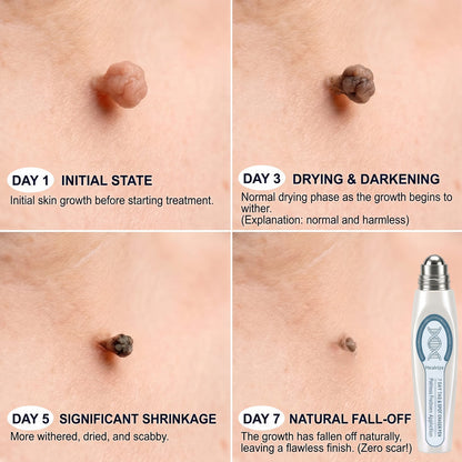 Healrize® 🖊 Advanced Wart & Skin Tag Removal Pen