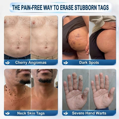Healrize® 🖊 Advanced Wart & Skin Tag Removal Pen