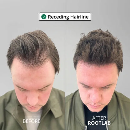 Apex Hair Regrowth System